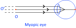 myopic eye