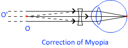 correction of myopia