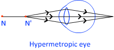hypermetropic eye