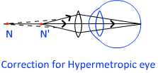 correction of hypermetropia